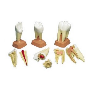 UPPER TRIPLE-ROOT MOLAR WITH CAVITIES, 2 PART